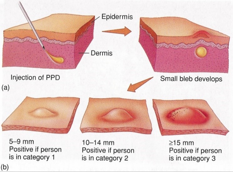 tuberculous-serpiginous-like